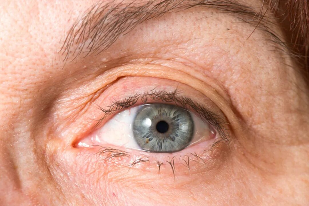 операция ультразвуковая факоэмульсификация катаракты. катаракта операция на 2 глаза. факоэмульсификация с имплантаций иол. катаракта операция на 2 глаза. ультразвуковая факоэмульсификация с имплантацией иол.