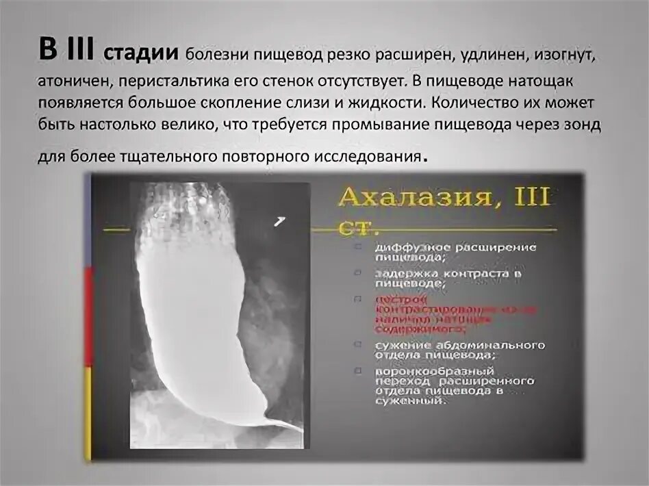 Ахалазия кардии пищевода что это. Ахалазия кардии пищевода что это. Степени ахалазии кардии рентген. Ахалазия кардии пищевода рентген. Ахалазия кардии пищевода что это.