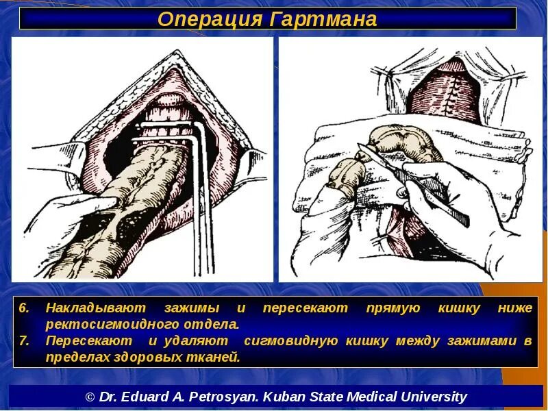 Операция толстой