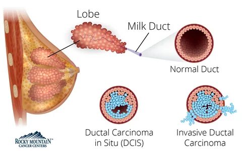 Stages Of Invasive Ductal Carcinoma