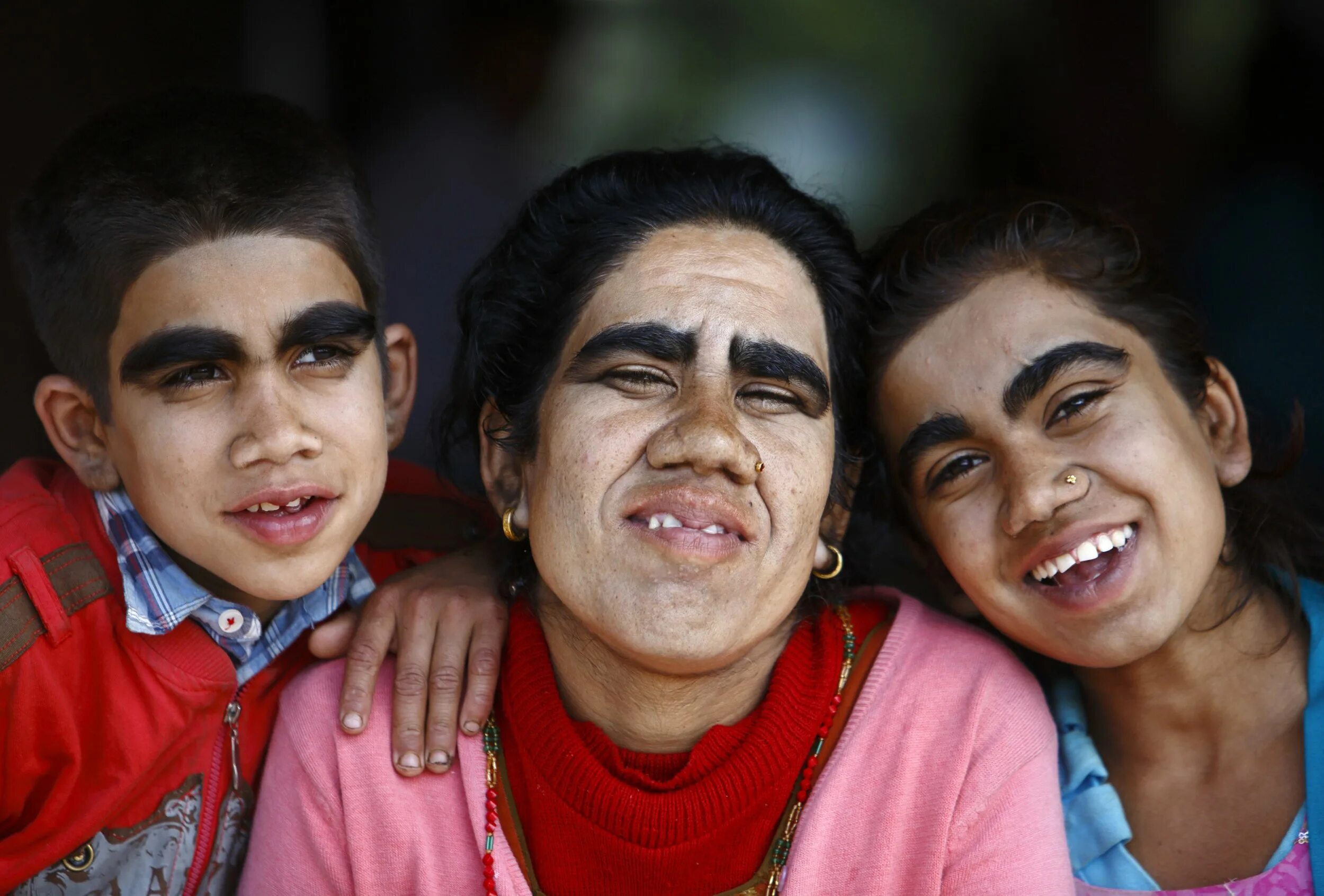 3 урода. Раджо певец. Синдром оборотня (гипертрихоз). Девочки оборотни из Индии. Страшный человек из Индии.