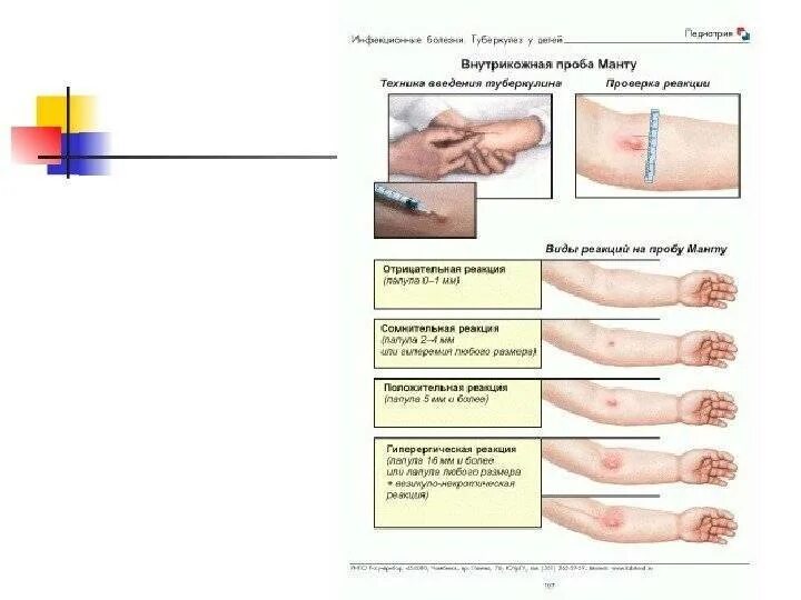 Через сколько делают диаскинтест. Туберкулиновая проба диаскинтест это. Отрицательная папула диаскинтест. Реакция манту и диаскинтест. Туберкулинодиагностика реакция манту.