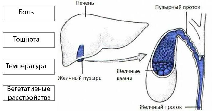 Боль в желчном пузыре чем снять. Желчекаменная болезнь.