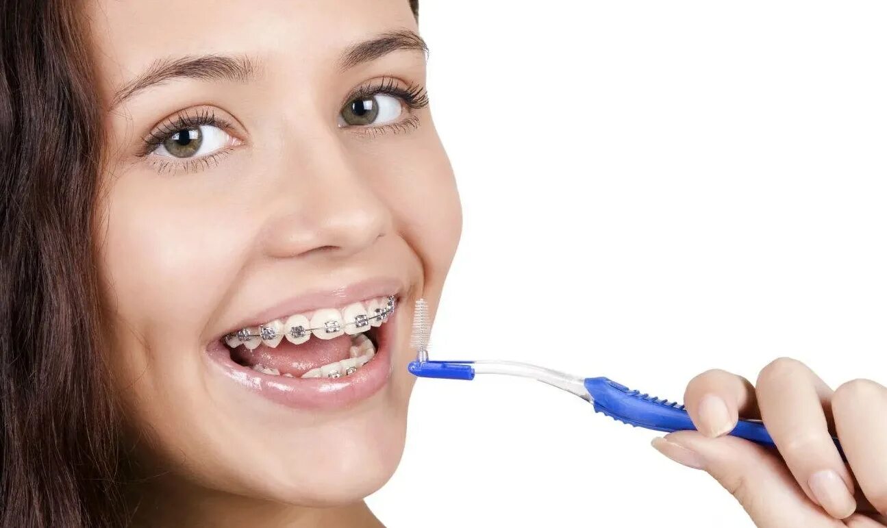 Зубы после 30. Брекеты. Гигиена полости рта с брекет системой. Правильная гигиена полости рта с брекетами.