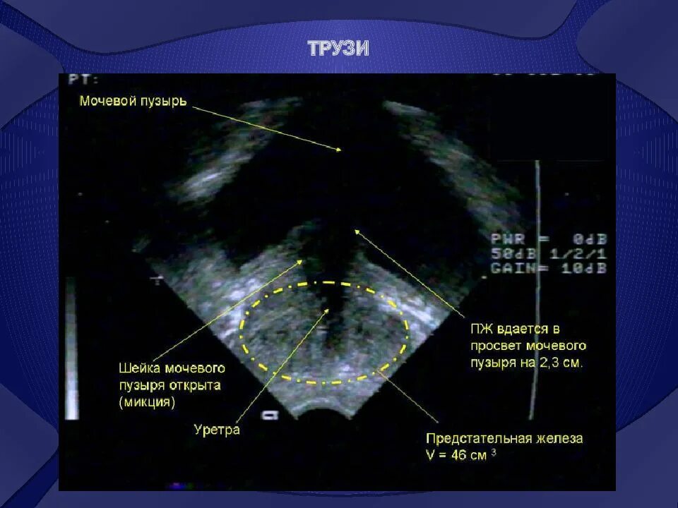 Трузи предстательной железы подготовка к исследованию. Ультразвуковое исследование предстательной железы трансректально. УЗИ трузи предстательной железы. Трузи предстательной железы и мочевого пузыря. Трансректальное УЗИ простаты норма.