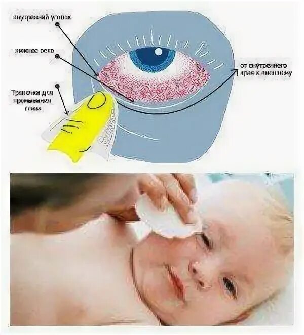 Коньюктивит чем промыть. Промывание глаз новорожденному. Как промывать глаза новорожденному. Обработка глаз грудного ребенка.
