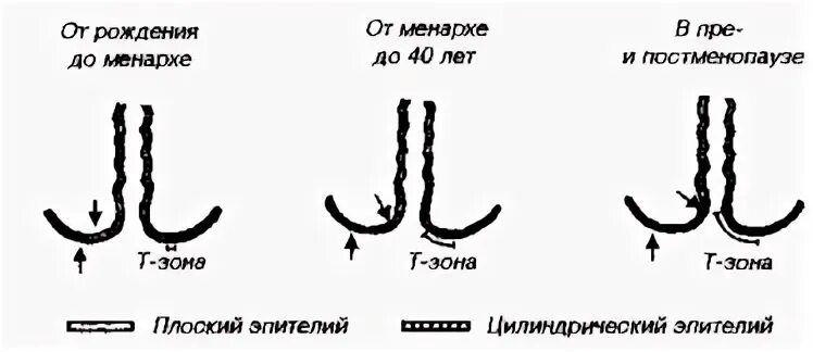 Типы зоны трансформации
