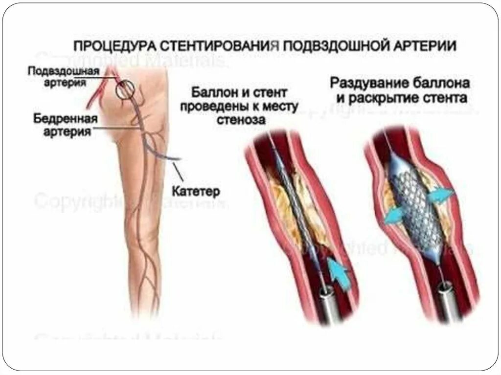 Операция на артерии нижних конечностей