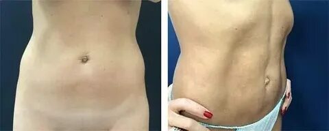 Липофилинг грудных желез до и после