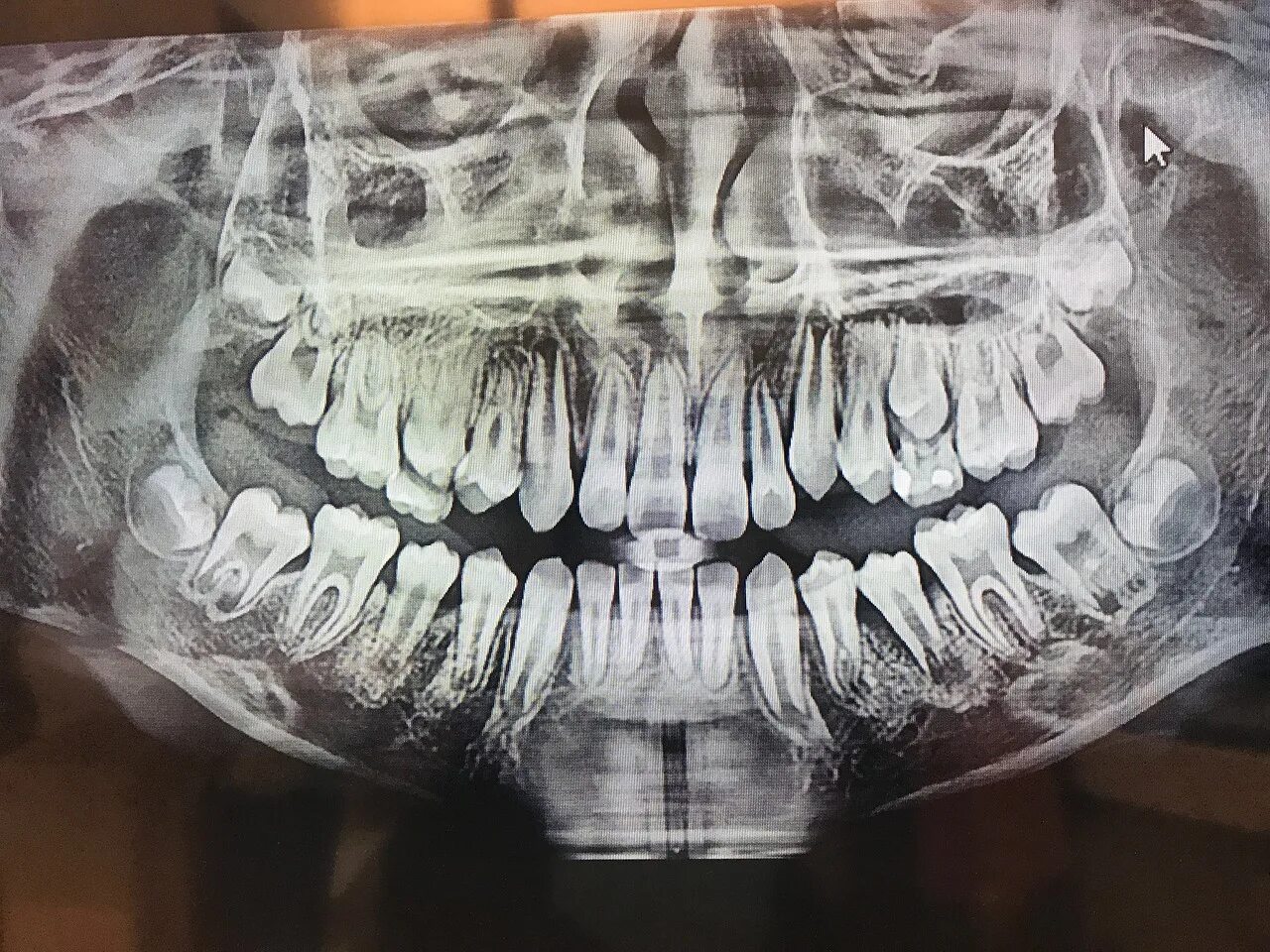 Рентгеновский снимок зубов.