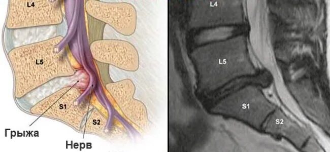 Грыжа межпозвоночного диска поясничного отдела l5-s1. Грыжа дисков l5-s1. Межпозвонковые диски l5-s1. Диски l5-s1 в позвоночнике. Крестцовый стеноз