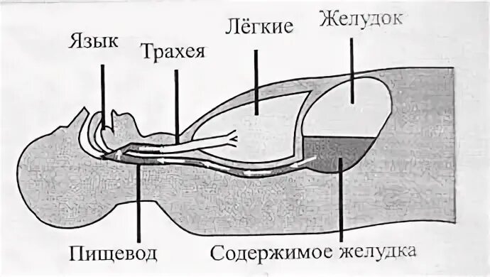 Удаление воздуха из желудка при искусственном дыхании. Регургитация желудочного содержимого. Аспирация содержимого желудка. При аспирации желудочного содержимого.