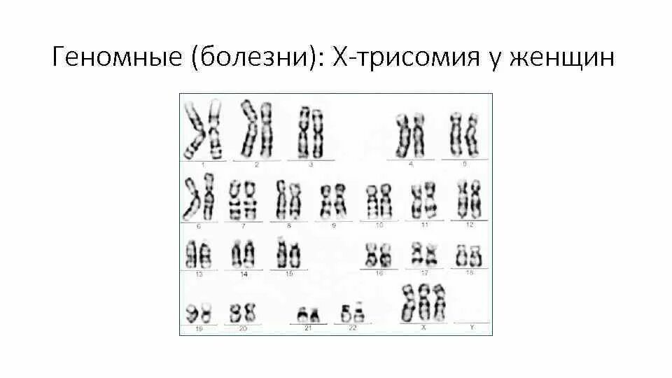 Синдром трипло. Трисомия х хромосомы это синдром. Кариотип трисомии х. Синдром трисомия х кариотип. Трисомия х хромосомы у женщин.