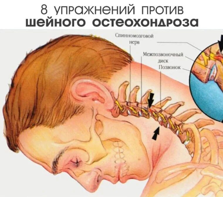 Остеохондроз болит ухо. Шейный остеохондроз упражнения. Упражнения против шейного остеохондроза. Восемь упражнений против шейного остеохондроза. Шейный хандроз упражнения.