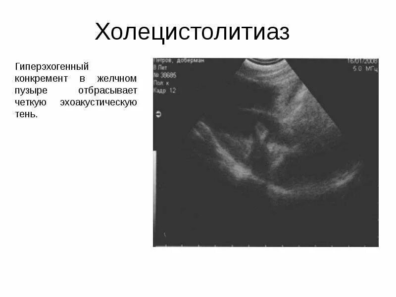 Холецистолитиаз желчного. Гиперэхогенный желчный пузырь УЗИ. Желчнокаменная болезнь холецистолитиаз. Холецистолитиаз желчного пузыря что это.