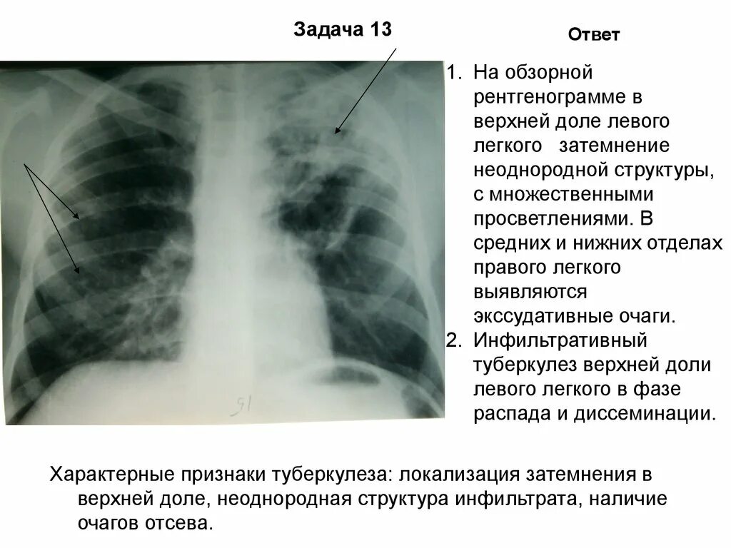 Изменение в верхнем легком. Инфильтративный туберкулез верхней доли рентген. Описание инфильтративного туберкулеза на рентгене. Описание рентген снимка грудной клетки. Инфильтративный туберкулез рентген описание.