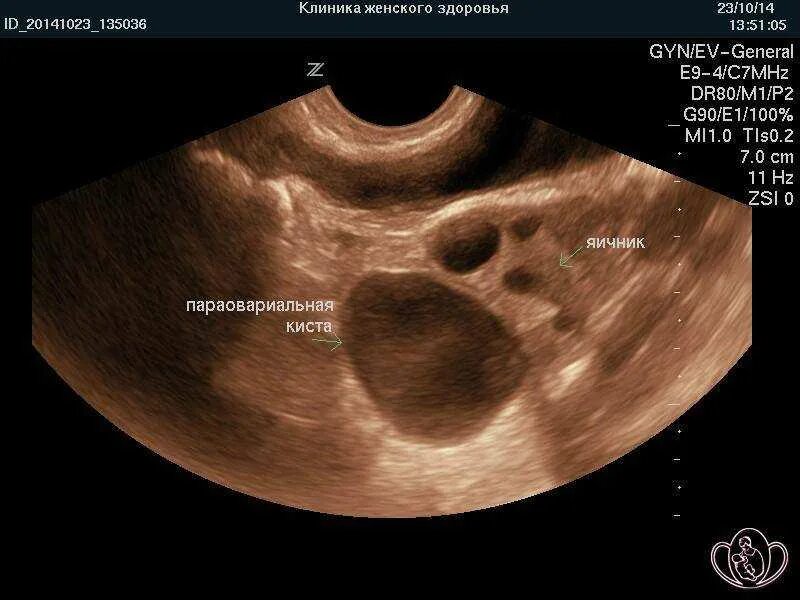 Параовариальная киста яичника. Параовулярная киста яичника. Фолликулярная киста яичника на УЗИ. Киста на узи видна