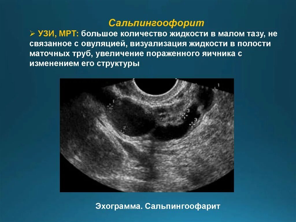 УЗИ при хроническом сальпингоофорите. Ультразвуковое исследование яичников. УЗИ измерение яичников. На узи видно воспаление