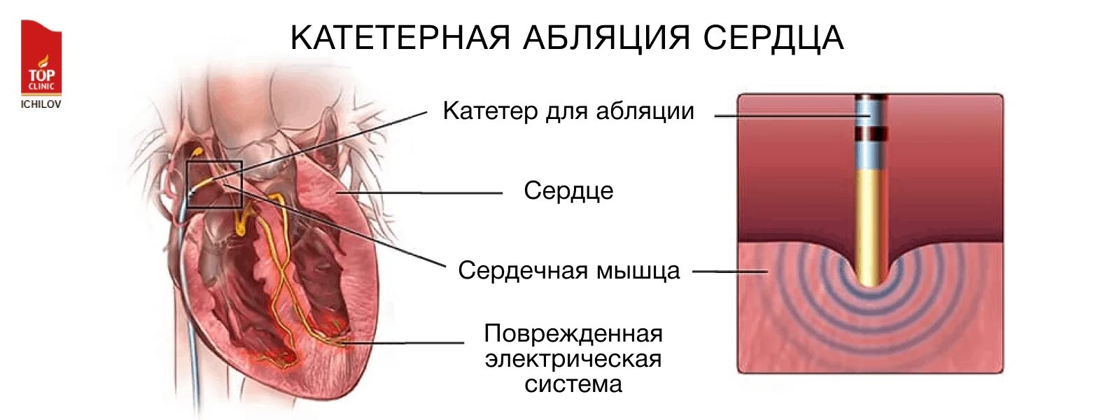 Где делают абляцию. Радиочастотная аблация аритмий сердца. Радиочастотная катетерная абляция сердца. Операция при мерцательной аритмии сердца прижигание.