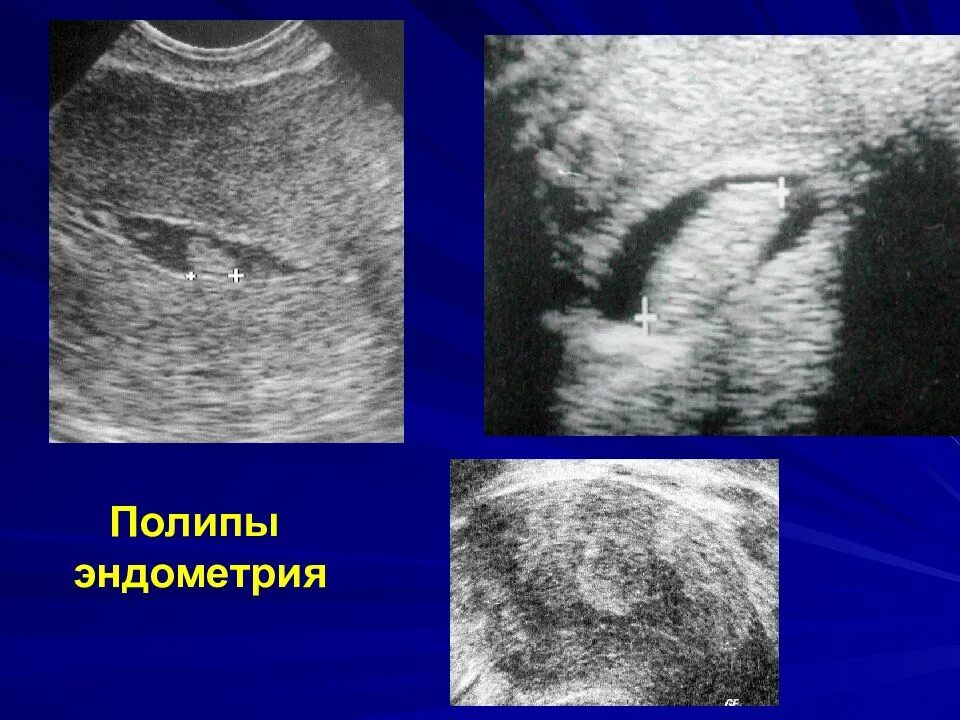 Чем опасна полип эндометрии