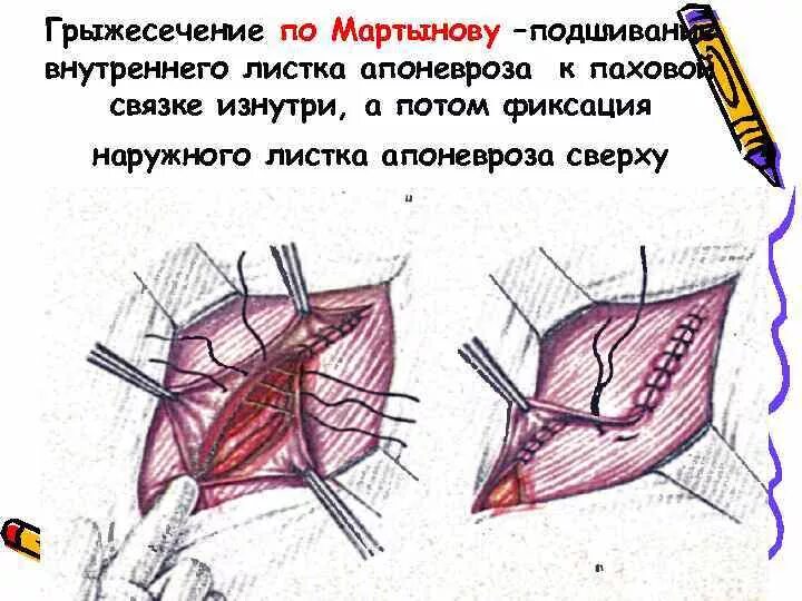 Больничный после операции на паховой грыже. Паховая грыжа операция по Мартынову. Паховая грыжа Мартынов. Схемы операций грыжесечения. Грыжесечение паховой грыжи по Мартынову.