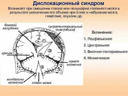 Дисфункции срединных структур у детей