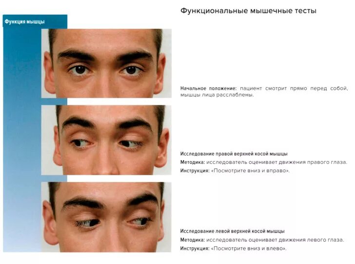Экзофтальм птоз офтальмоплегия. Паралич глазных мышц. Птоз верхнего века парез глазодвигательного нерва. Парез глазодвигательного нерва. Паралич глазных мышц.