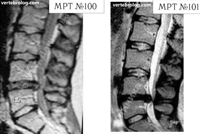 Секвестрированная грыжа l5-s1. Межпозвонковая грыжа мрт. Грыжа диска позвоночника мрт. Грыжа межпозвоночного диска мрт. После операция грыжа диска