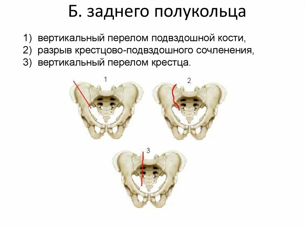 Тазовое смещение. Перелом кости лонного сочленения. Классификация перелом лонной кости таза. Перелом симфиза лонного сочленения. Перелом крестцово подвздошного сочленения.