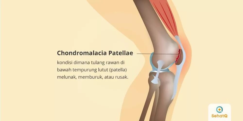 Хондромаляция мыщелка. Хондромаляция надколенника 4. Хондромаляция надколенника 2. Хондромаляция надколенника 3. Хондромаляция надколенника коленного сустава.