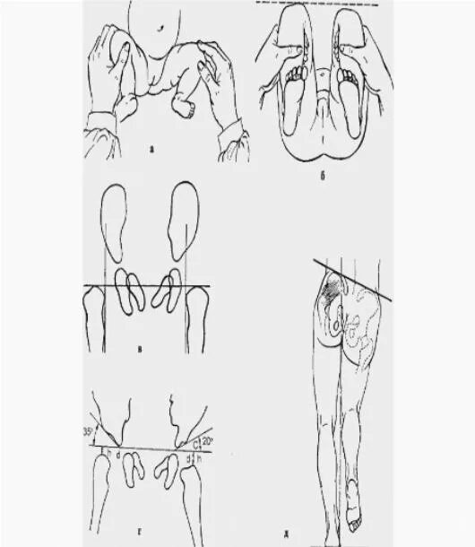 Операция на вывих тазобедренного сустава у ребенка. Операции при врожденном вывихе. Врожденный вывих тазобедренного сустава. Хирургическая анатомия врожденного вывиха бедра. Операции при врожденном вывихе.