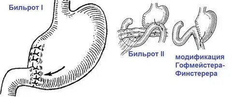 Бильрот 2 в модификации