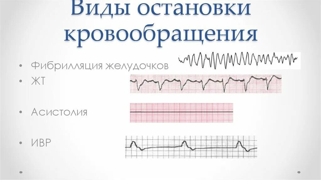 Виды остановки кровообращения. Виды остановки кровообращения на ЭКГ. ЭКГ ритмы внезапной остановки кровообращения. Асистолия желудочков на ЭКГ. Варианты остановки кровообращения