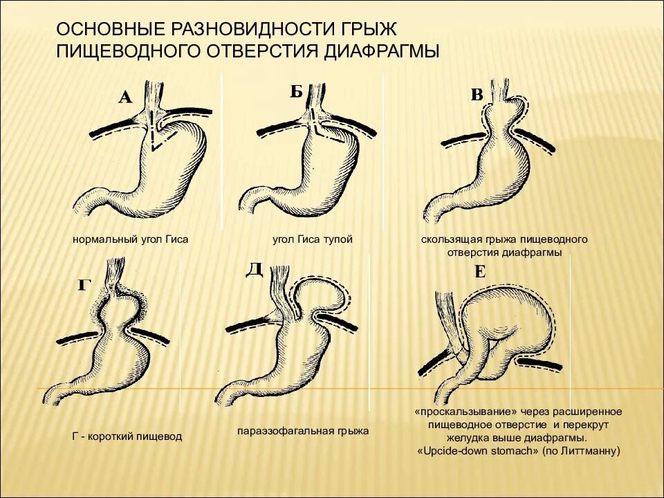 Скользящая грыжа под. Грыжа пищеводного отдела диафрагмы классификация. Пищеводная грыжа пищеводного отверстия. Диафрагмальное отверстие пищевода. Скользящей грыжи пищеводного отверстия диафрагмы.