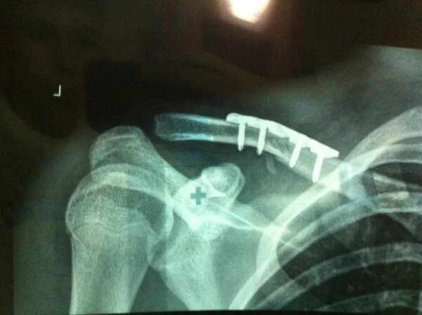 остеосинтез перелома ключицы спицами. вколоченный перелом ключицы. экстрамедуллярный остеосинтез ключицы. перелом ключицы операция. закрытый оскольчатый перелом ключицы.