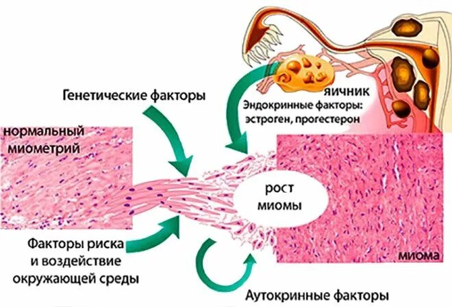 Причины появления миом. Патогенез миомы матки схема. Миома механизм развития. Механизм развития фибромиомы матки. Патогенез лейомиомы матки схема.