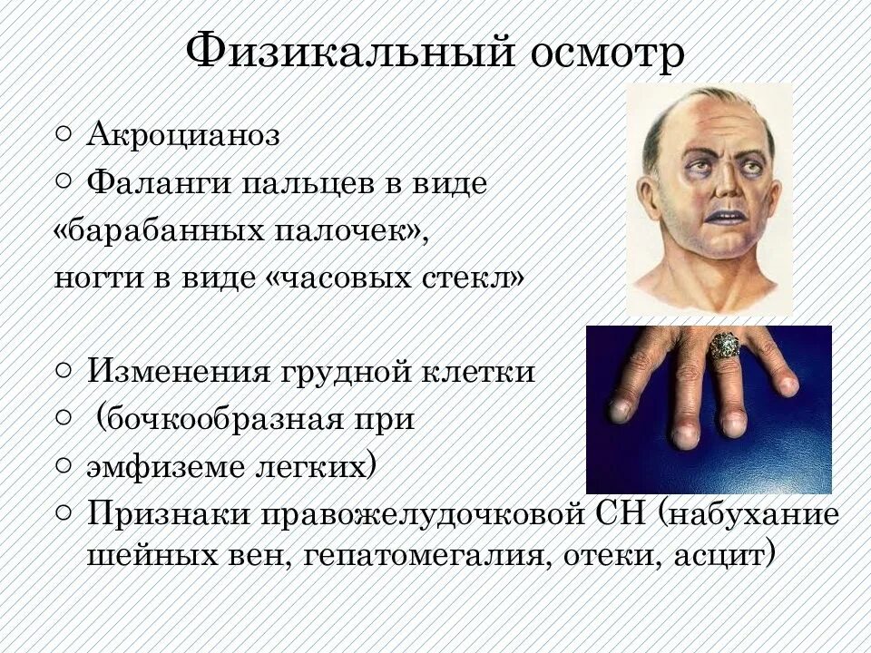 Симптом часовых. Симптом часовых