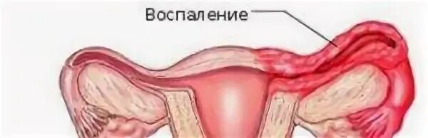 Воспаление придатков как называется. Воспаление яичников аднексит. пиосальпинкс симптомы.