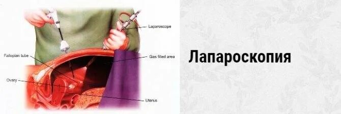 Операция внематочной беременности лапароскопии. Внематочная Трубная беременность лапароскопия. Лапароскопия при внематочная беременности операция. Внематочная беременност ьопреация. Месячные после удаления трубы