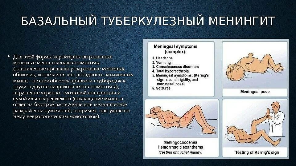 Менингит последствия у взрослых. Менингиты менингококковая инфекция симптомы. Менингококковая инфекция ригидность. Симптомы менингококковый менингит неврология. Туберкулезный менингит симптомы.