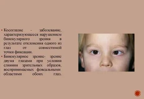 Сходящееся косоглазие код по мкб у детей