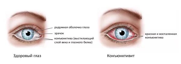 Конъюнктивит ребенок 7 лет. Заболевания вспомогательного аппарата глаза: конъюнктивит. Конъюнктивит симптомы у детей 3.