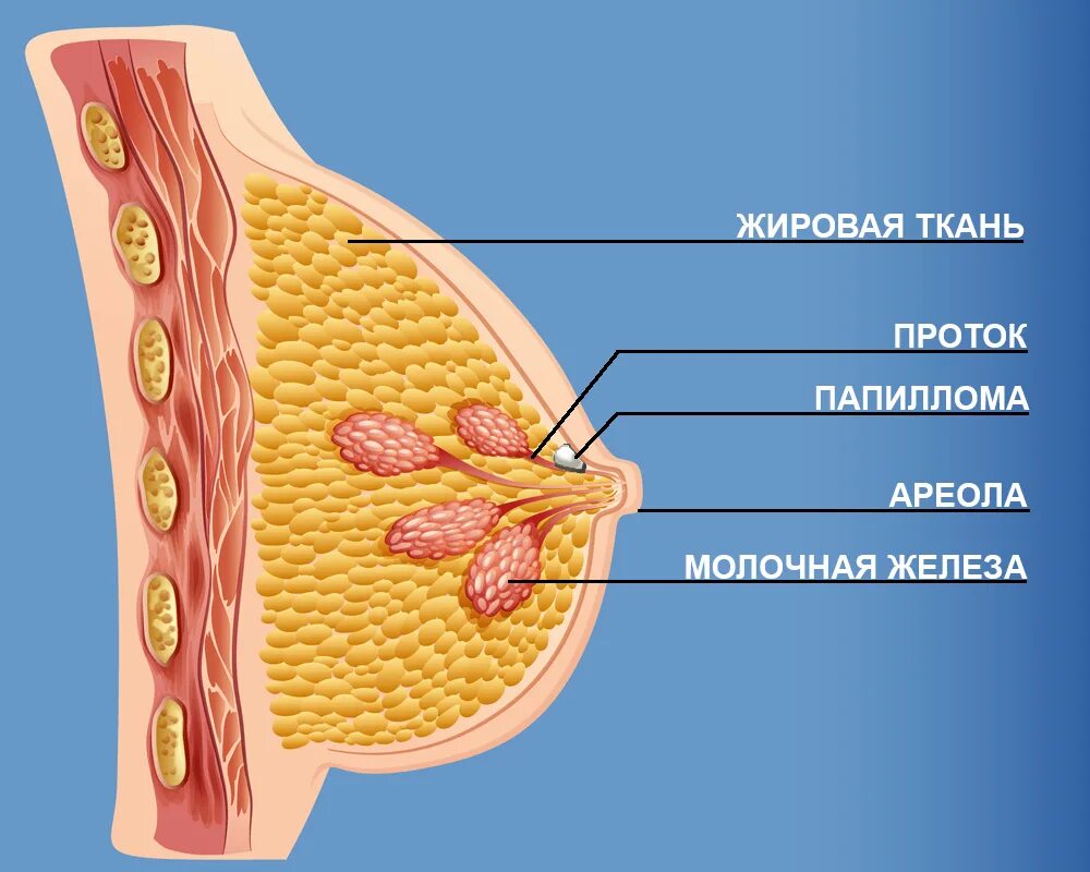 Папилломы протоков молочных желез