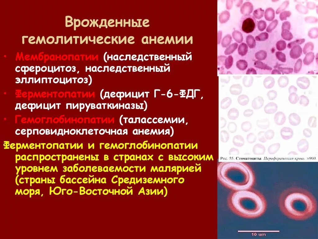 Гемоглобинопатии гемолитическая анемия. Серповидноклеточная анемия морфология. Серповидноклеточная анемия у животных. Гемолитическая анемия гипохромия. Врожденные гемолитические анемии