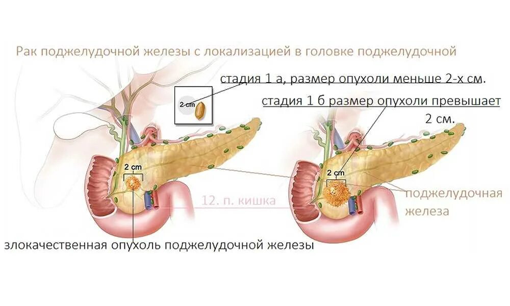 Панкреатит головка. Опухоль головки поджелудочной железы. Поджелудочная железа образование головки поджелудочной. Виды злокачественных опухолей поджелудочной железы. Злокачественное образование поджелудочной железы.