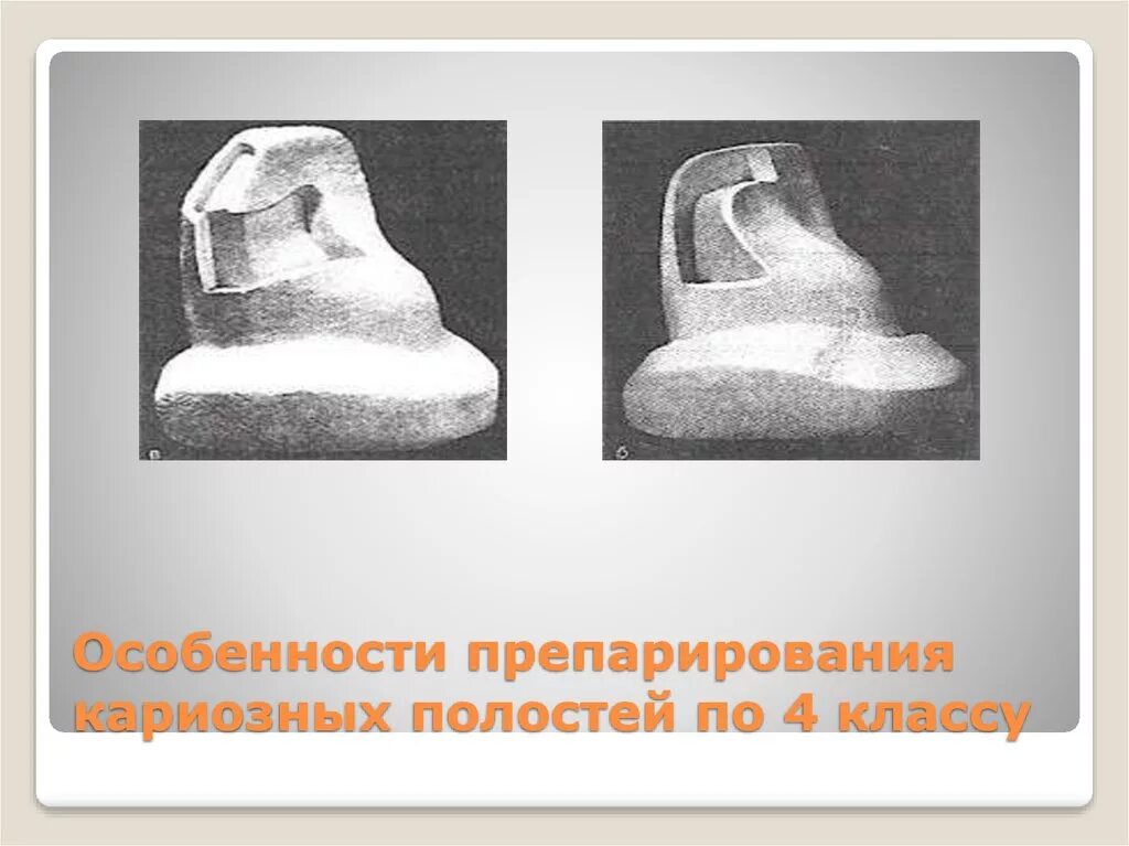 Препарирование полостей 4 класса. Особенности препарирования. препарирование кариозных полостей 4 класса. препарирование 4 класса по блэку. особенности препарирования кариозных полостей 4 класса.
