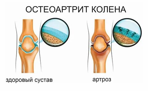 Разрушение суставов