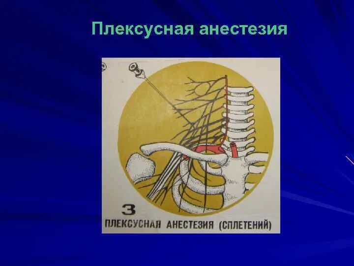 Блокада сплетения. Анестезия плечевого сплетения по Куленкампфу. Плексусная анестезия. Проводниковая и плексусная анестезия. Плексусная регионарная анестезия.