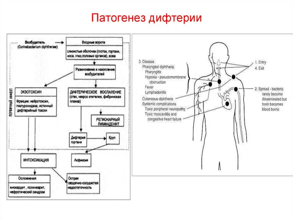 Этиология,пути передачи,патогенез дифтерии. Патогенез дифтерии ротоглотки. Дифтерия патогенез кратко. Патогенез дифтерии клинические формы. Этиология дифтерии