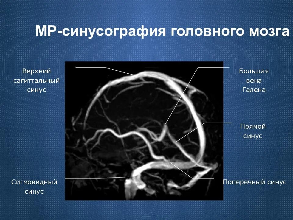 Синусы мозга мрт. Тромбоз поперечного синуса головного мозга на кт. аневризма сагиттального синуса. прямой синус вена галена мрт головного.